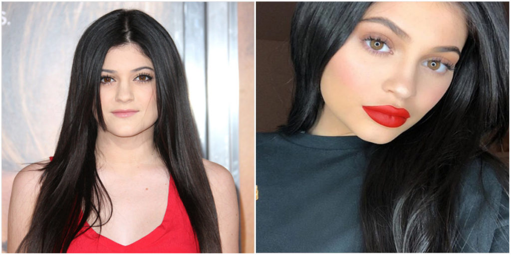 Cirugías De Kylie Jenner Antes Y Después Cirugiasde 