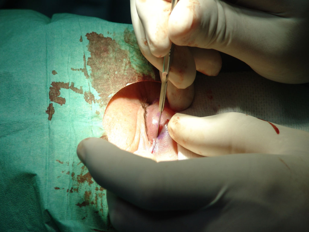 Cirugía blaferoplastia