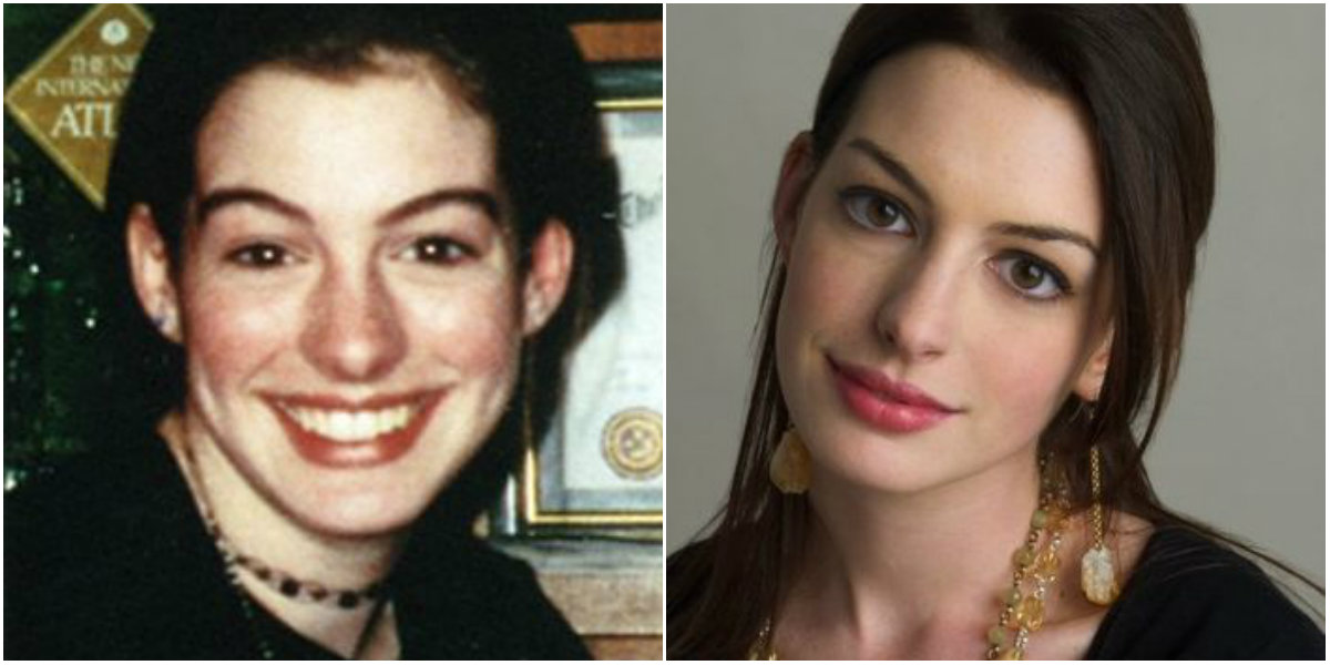 Anne Hathaway cirugías
