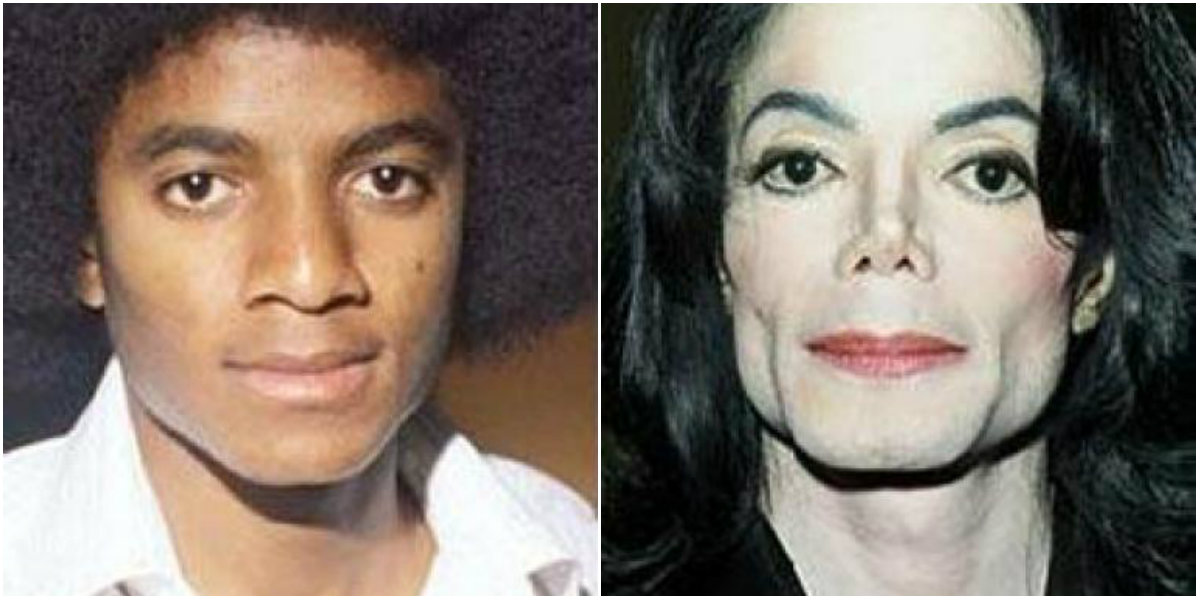 Michael Jackson Cirugías