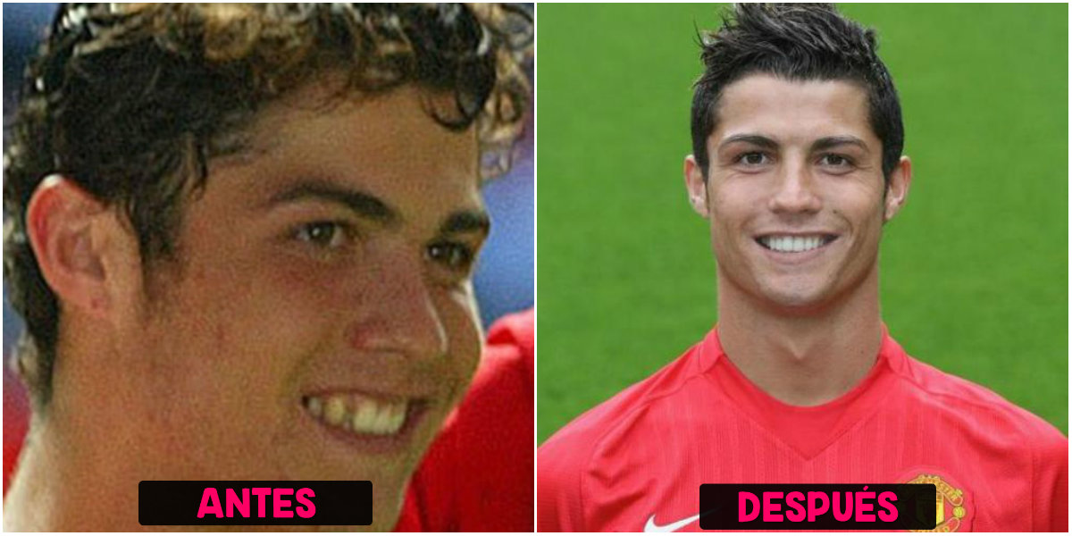 Ortodoncia de Cristiano Ronaldo