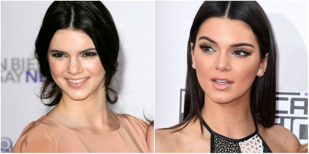 Cirugías De Kendall Jenner Antes Y Después Cirugiasde 