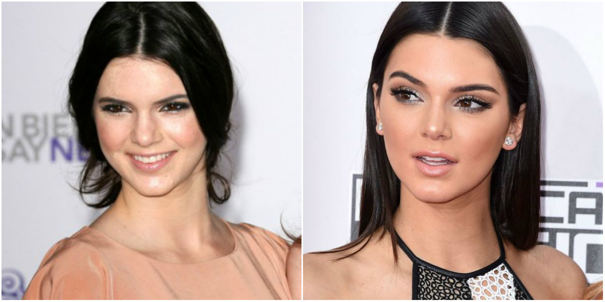 Cirugías plásticas de Kendall Jenner