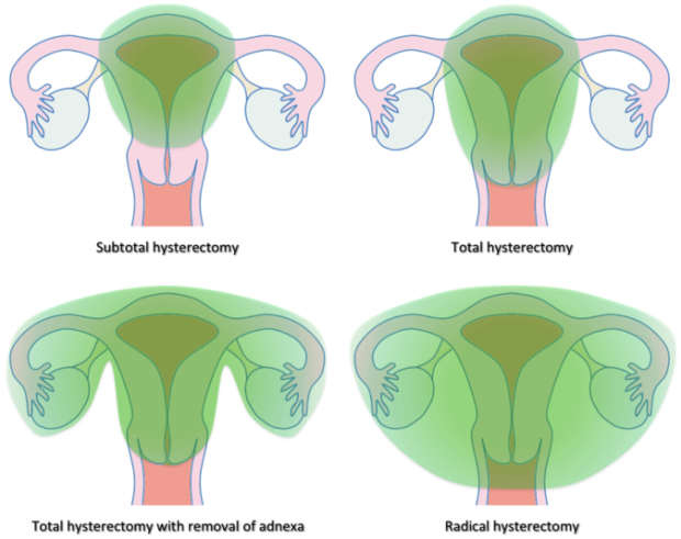 Tipos de Histerectomía