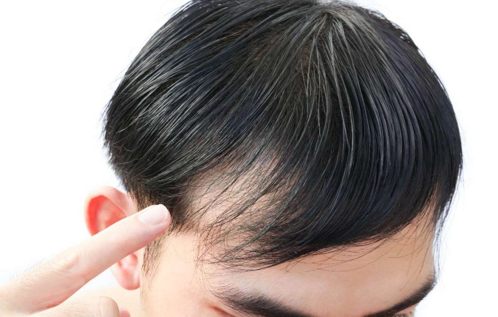 Efectos secundarios del implante de pelo